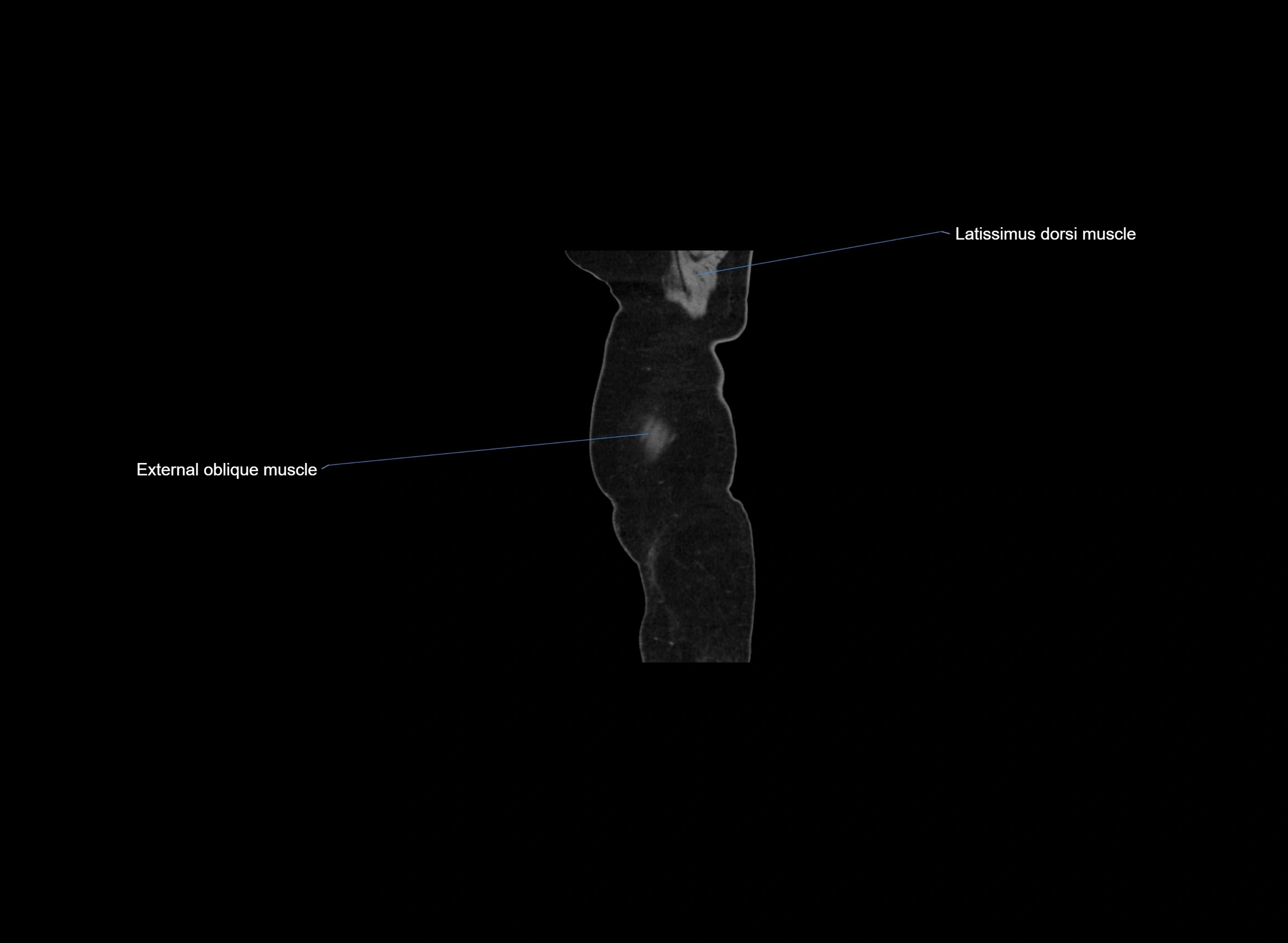 CT Abdomen sagittal cross sectional anatomy labelled radiology image -00110.webp